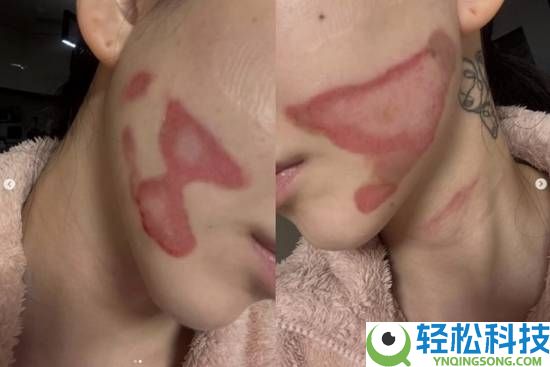 烧的太惨烈,韩国女星做医美居然致使面度灼伤