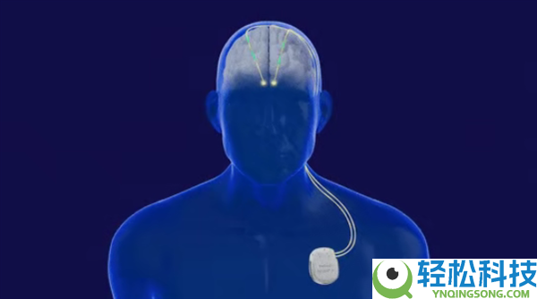 广西成功展开首例脑机接口手术:帕金森患者将完成生涯自理,