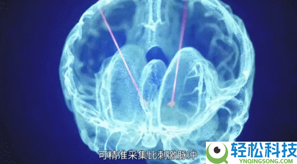 广西成功展开首例脑机接口手术:帕金森患者将完成生涯自理,