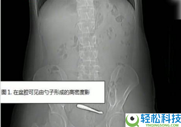 瞠目结舌：南京一小伙腹痛CT查出肠道卡2把勺子 婉言吞下时没发觉