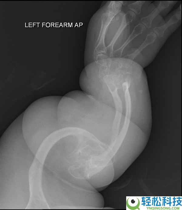 1个月女婴多处骨折 父母险被抓 一查竟是稀有病