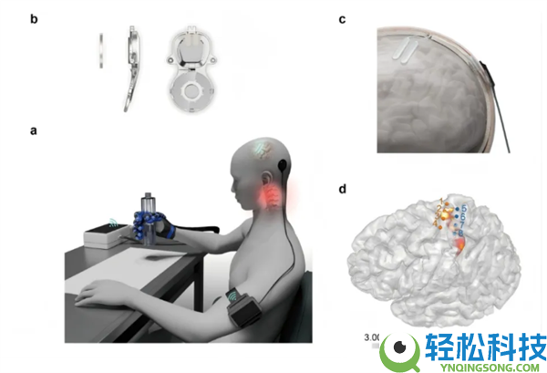 侵入式脑机接口医疗器械上市：瘫痪患者完成用手写字