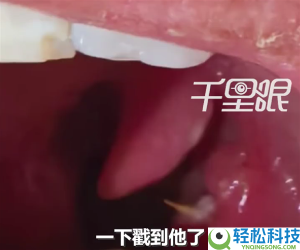 男人竹签卡喉误认为刀片嗓：吃8天药越吃越严重
