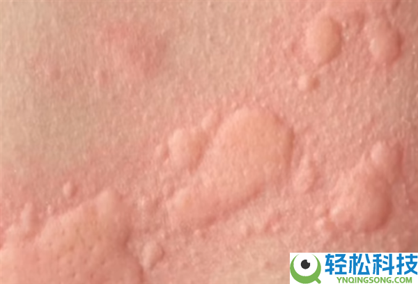 无治愈手腕只能靠药物减缓 全球多国呈现麻疹疫情反弹