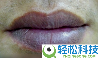 嘴唇发紫就是心脏不好吗 更主要的是看这一点